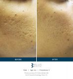 SkinPen-Marketing-SoMe-content_Pictures_Before-After_Before-and-After-Picture-31631401056919-scaled