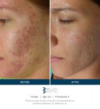 SkinPen-Marketing-SoMe-content_Pictures_Before-After_Before-and-After-Picture-51631401056919-1-scaled