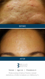SkinPen-Marketing-SoMe-content_Pictures_Before-After_Before-and-After-Picture-61631401056919