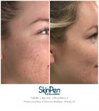 SkinPen-Marketing-SoMe-content_Pictures_Before-After_Before-and-After-Picture-91631401056920